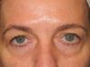 Blepharoplasty case #4034