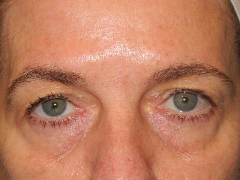 Blepharoplasty case #6472