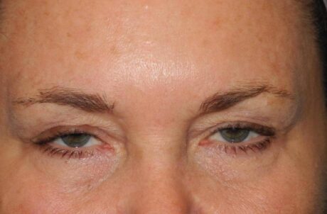 Blepharoplasty case #4086