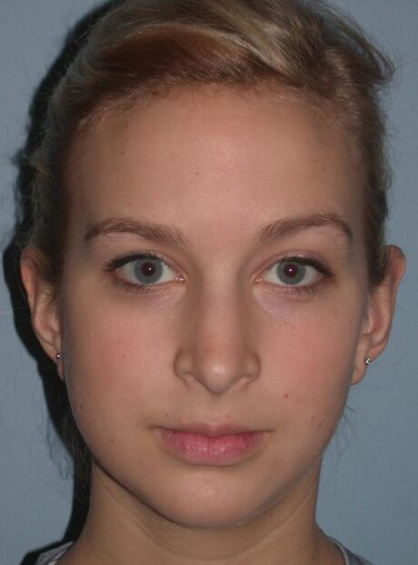 Rhinoplasty case #5414