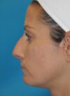 Rhinoplasty case #4123