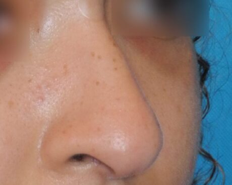 Liquid Rhinoplasty case #4124