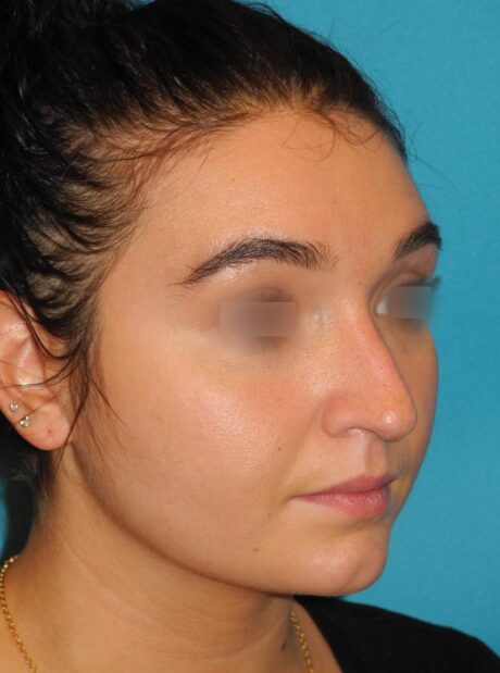 Revision Rhinoplasty case #3466