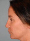 Rhinoplasty case #3690