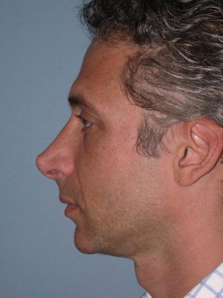 Revision Rhinoplasty case #3492