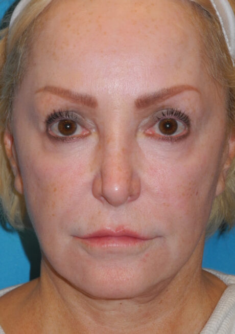 CO2 Laser Resurfacing case #4635