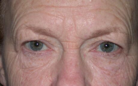 CO2 Laser Resurfacing case #4637