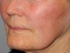 CO2 Laser Resurfacing case #4638