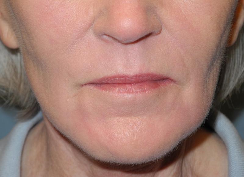 CO2 Laser Resurfacing case #4679