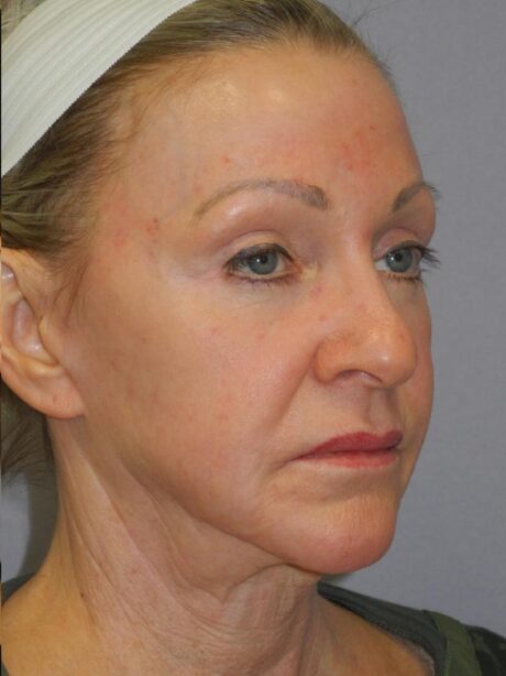 CO2 Laser Resurfacing case #4681