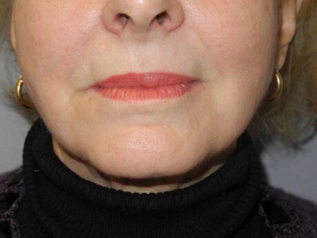 CO2 Laser Resurfacing case #4684