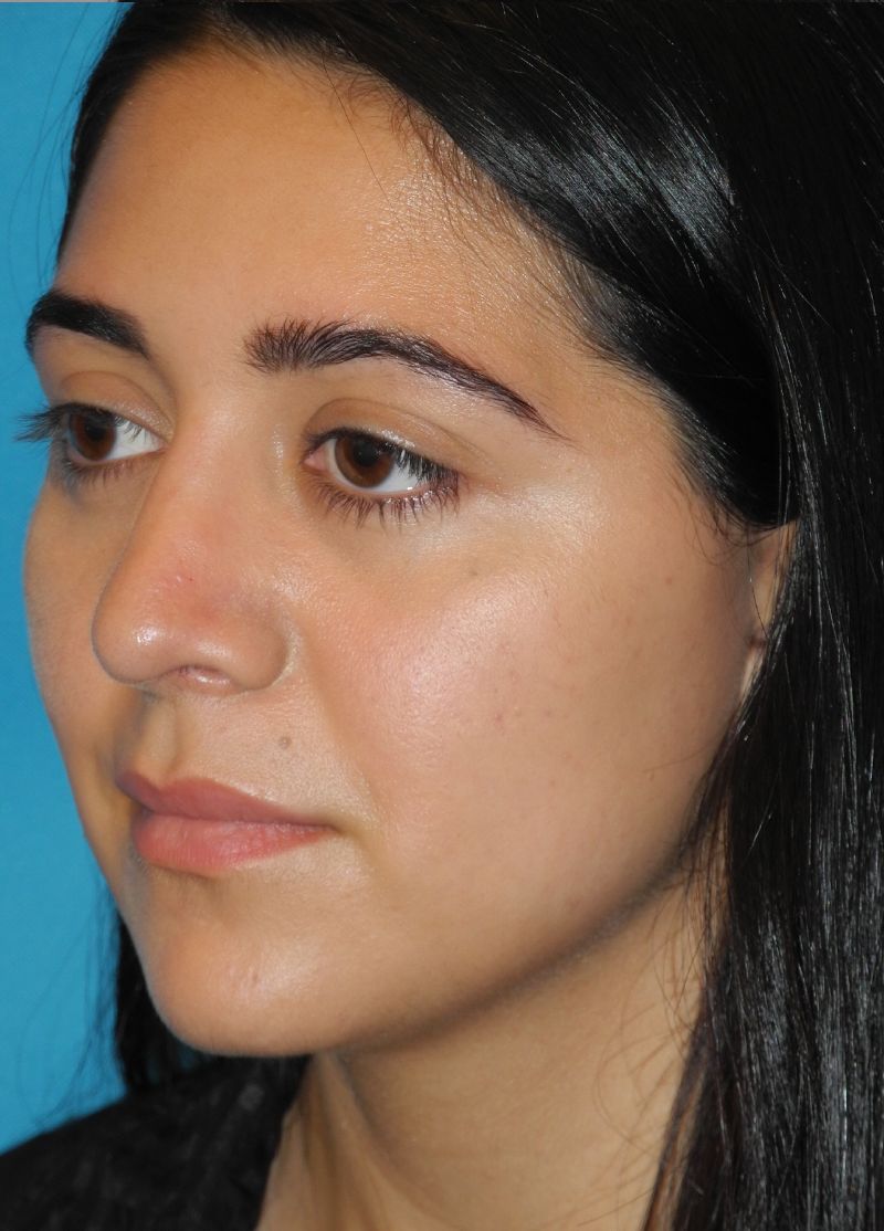 Rhinoplasty case #3518