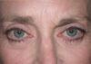 Blepharoplasty case #4790