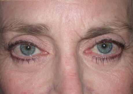 Blepharoplasty case #4790