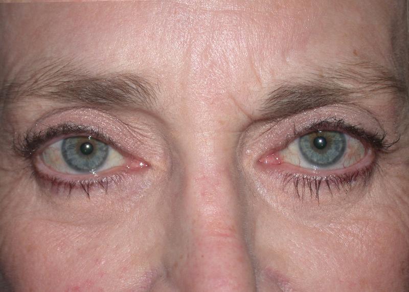 Blepharoplasty case #6469