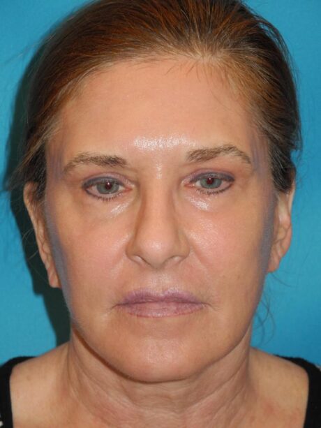 CO2 Laser Resurfacing case #4753