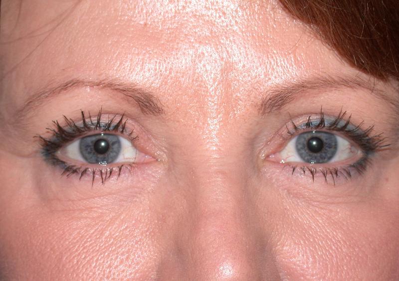 Blepharoplasty case #4819