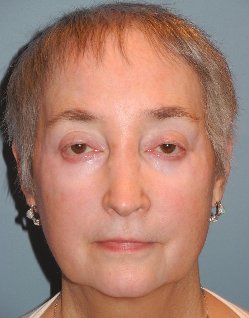 Blepharoplasty case #4858