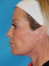 CO2 Laser Resurfacing case #4756