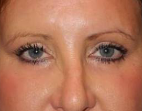 Blepharoplasty case #3877