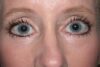 Blepharoplasty case #4941