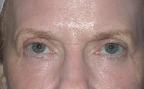 Blepharoplasty case #4948