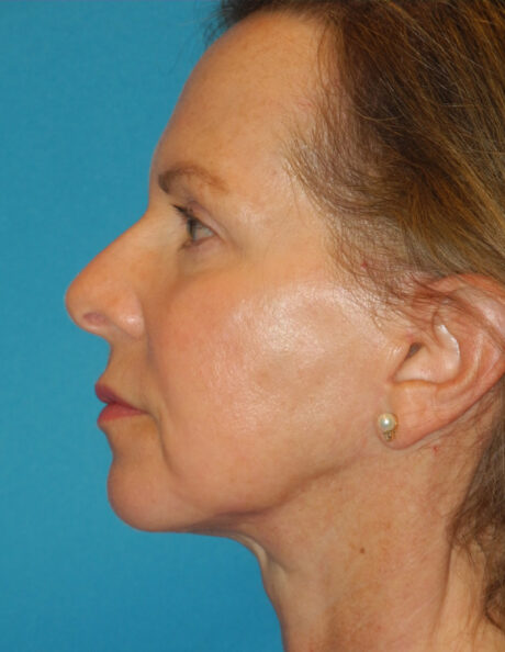 Blepharoplasty case #4966