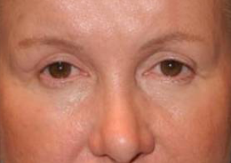 Blepharoplasty case #3896