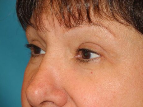 Blepharoplasty case #5141