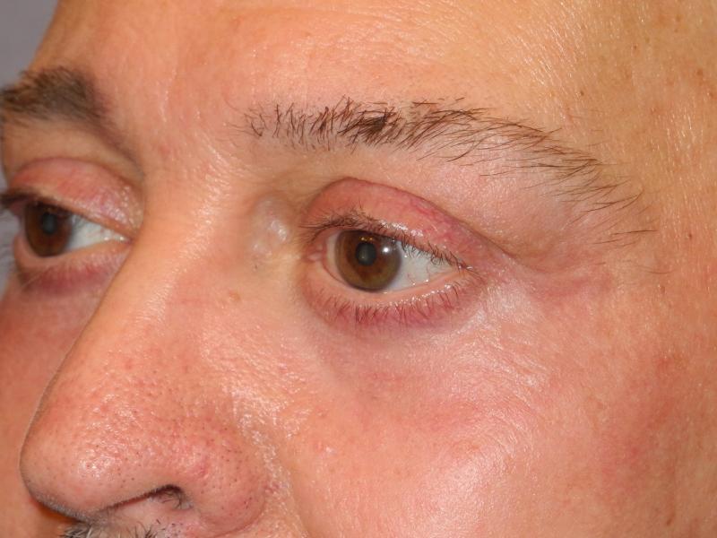 Blepharoplasty case #5148