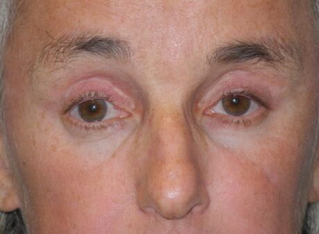 Blepharoplasty case #5160