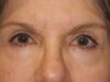 Blepharoplasty case #5167