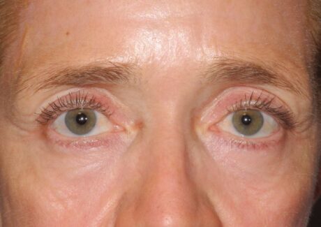 Blepharoplasty case #5175