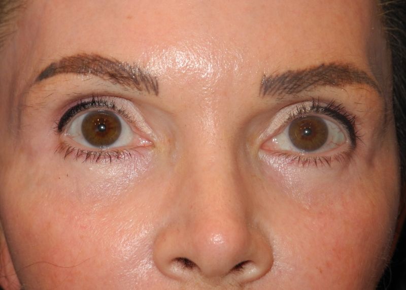 Blepharoplasty case #5186