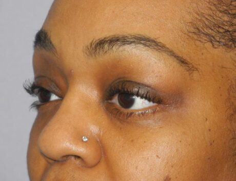 Blepharoplasty case #5204