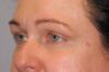 Blepharoplasty case #5225