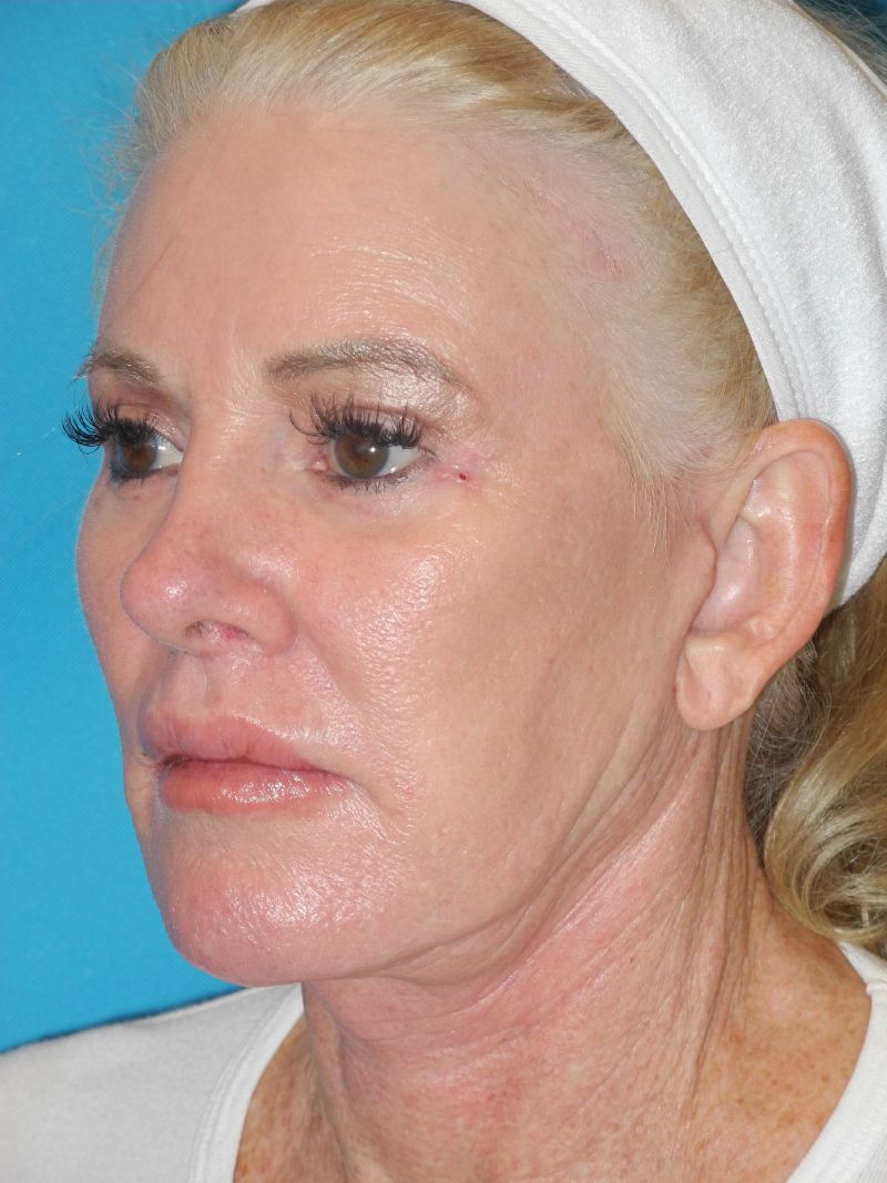 Blepharoplasty case #5235