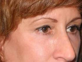 Blepharoplasty case #6471