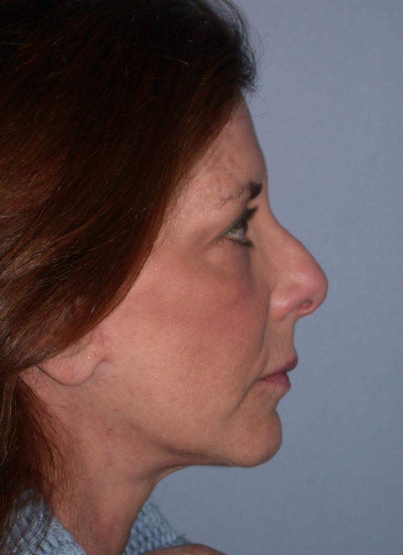 Neck Lift case #5321