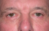 Blepharoplasty case #4777