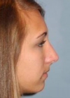 Rhinoplasty case #3514