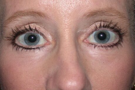 Blepharoplasty case #6474