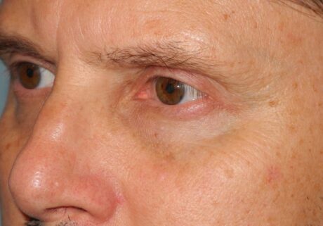 Blepharoplasty case #3977