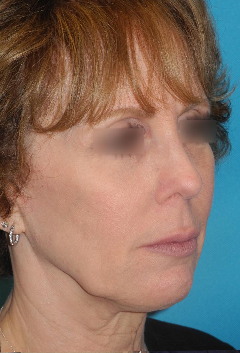 Revision Rhinoplasty case #3464