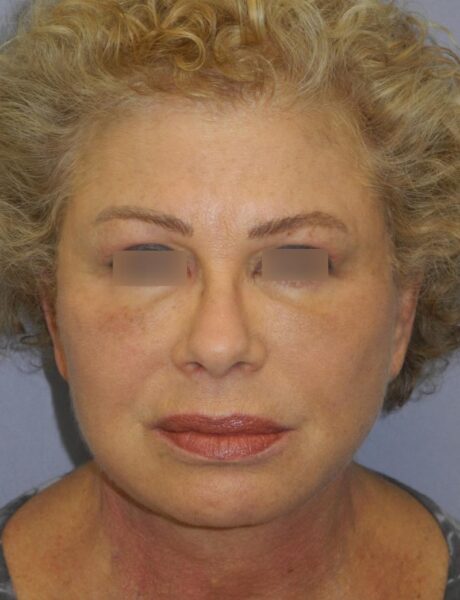 Blepharoplasty case #3989