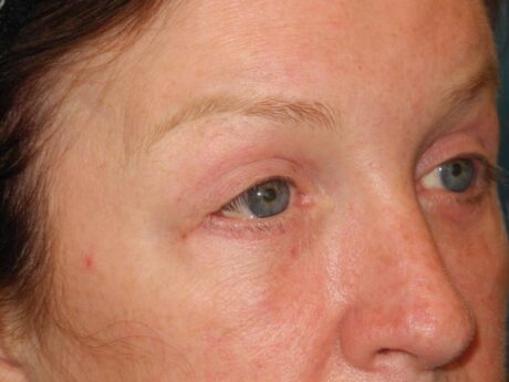 Blepharoplasty case #4024