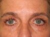 Blepharoplasty case #4034