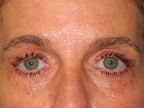 Blepharoplasty case #6472