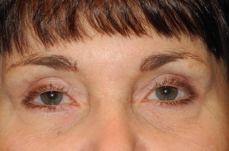 Blepharoplasty case #4086