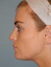 Otoplasty case #3909